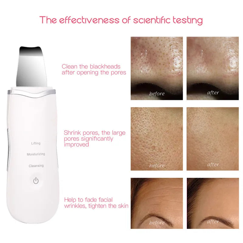 Ultrasonic Skin Scrubber Spatula Blackhead Remover - 8