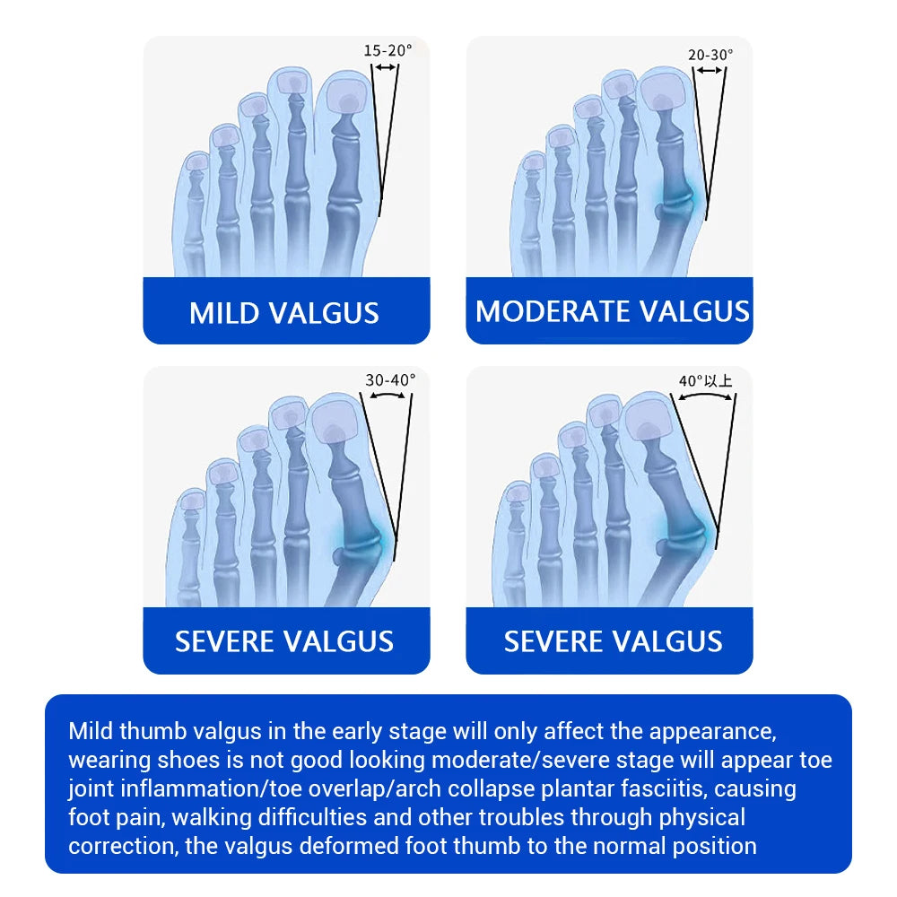 Adjustable Toe Straightener Bunion Corrector Splint - 5