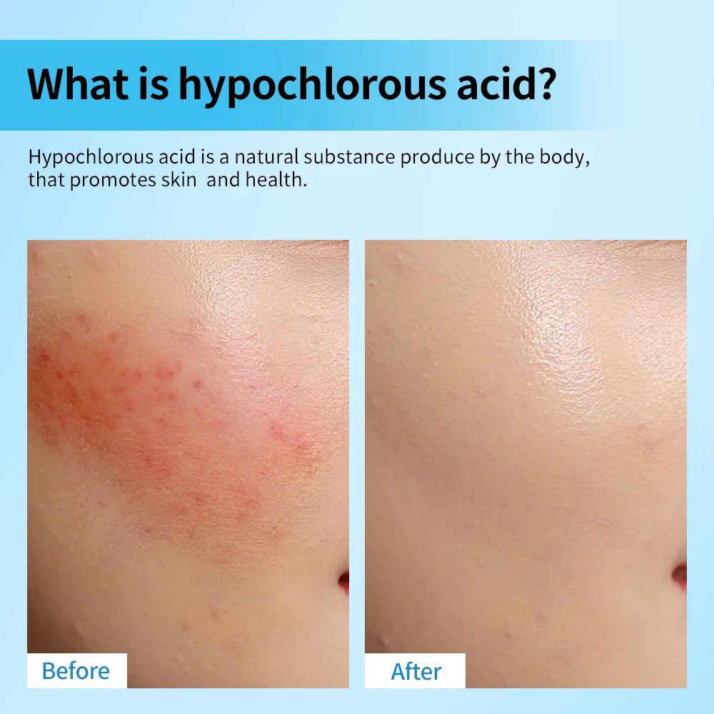 Hypochlorous Acid Facial Spray Skin Care Toner