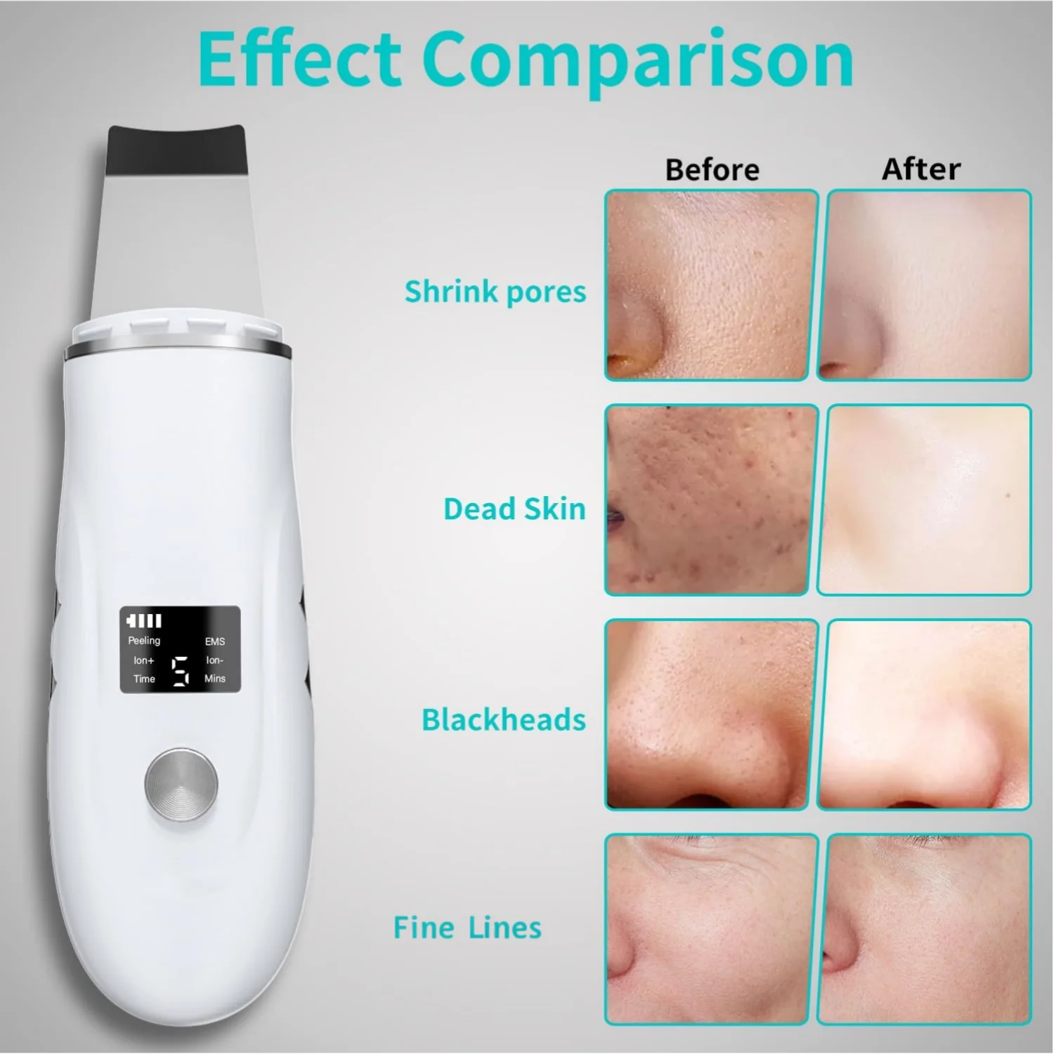 4 in 1 Ultrasonic Facial Skin Scrubber & Blackhead Remover Spatula - 3