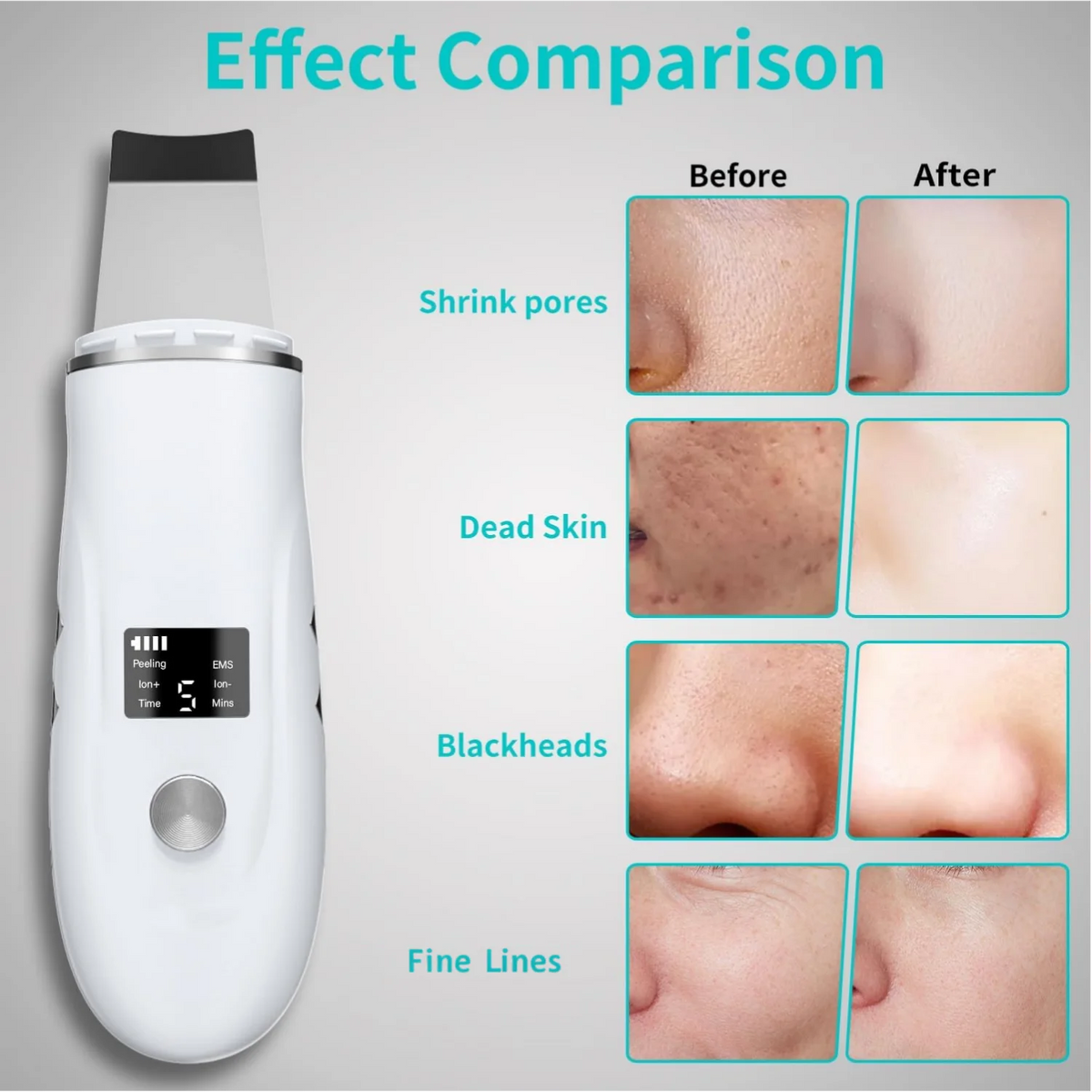4 in 1 Ultrasonic Facial Skin Scrubber & Blackhead Remover Spatula