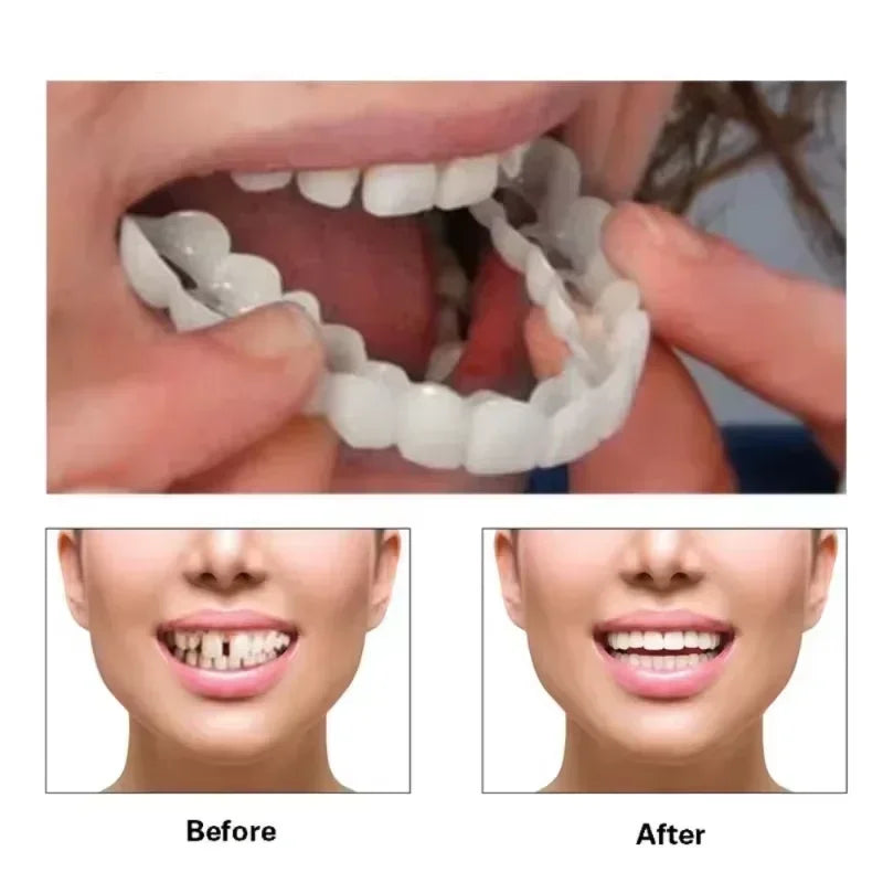 Denture Silicone Kit Soft Liners Upper And Lower Teeth Set - 1