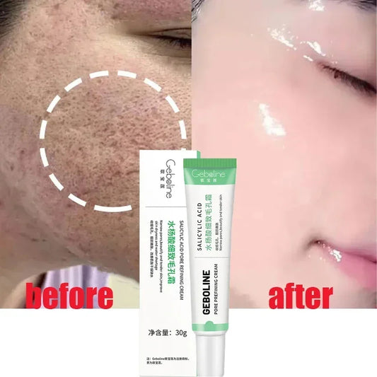Salicylic Acid Pore Shrinking Cream Acne Scar Removal Face Smooth