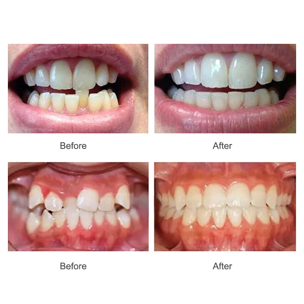 3 Stages Dental Braces Teeth Trainer Alignment Mouthpiece