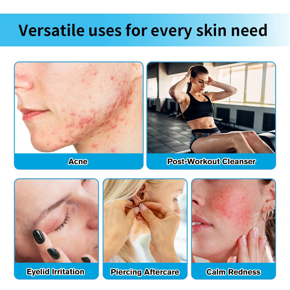 Hypochlorous Acid Facial Spray Redness Acne Post Workout Cleanser